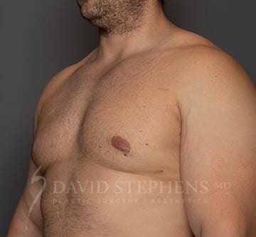 Cosmetic Surgery for Men - Actual Patient Results - After - 2