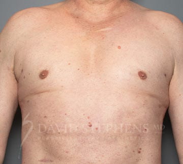 Gynecomastia-Patient-04 | After Gynecomastia