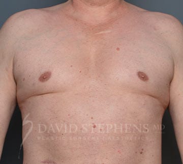 Gynecomastia-Patient-04 | Before Gynecomastia