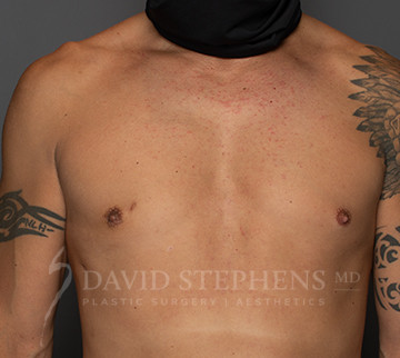 Gynecomastia-Patient-05 | After Gynecomastia