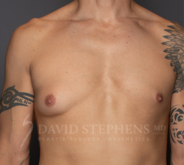 Gynecomastia-Patient-05 | Before Gynecomastia