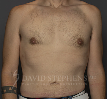 Gynecomastia-Patient-06 | After Gynecomastia