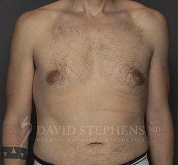 Gynecomastia-Patient-06 | Before Gynecomastia