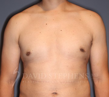Male Breast Reduction - Actual Patient Results - After - 2