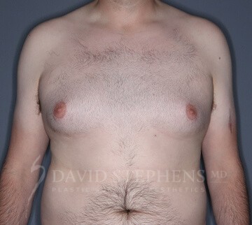 Male Breast Reduction - Actual Patient Results - Before - 1