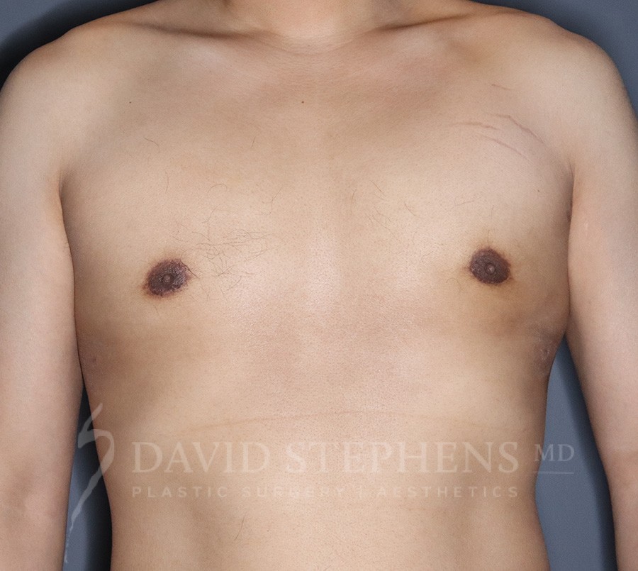 Male Breast Reduction - Actual Patient Results - After - 3