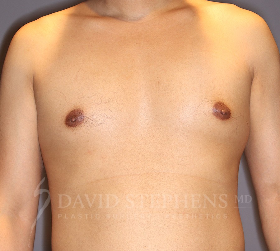 Male Breast Reduction - Actual Patient Results - Before - 3