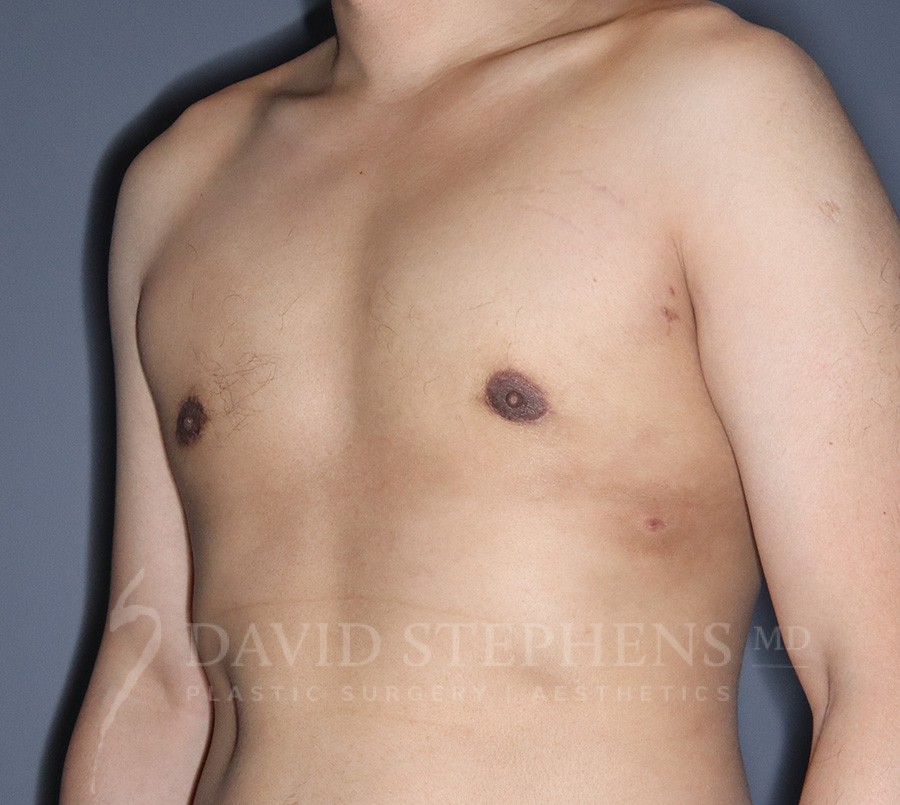 Chipstuttar Gynecomastia Patient 09 | David Stephens, MD Plastic Surgery & Medical ...