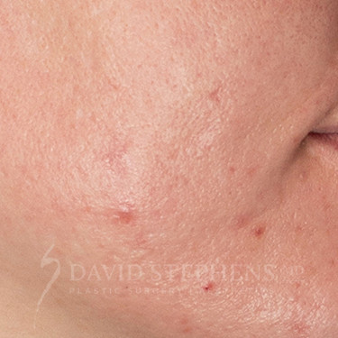 HALO-Patient-05 | After HALO