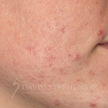 HALO-Patient-05 | Before HALO