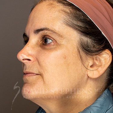 HALO-Patient-06 | After HALO