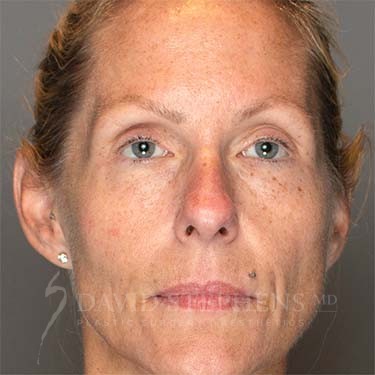 HALO-Patient-07 | Before HALO