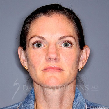 HALO-Patient-10 | Before HALO