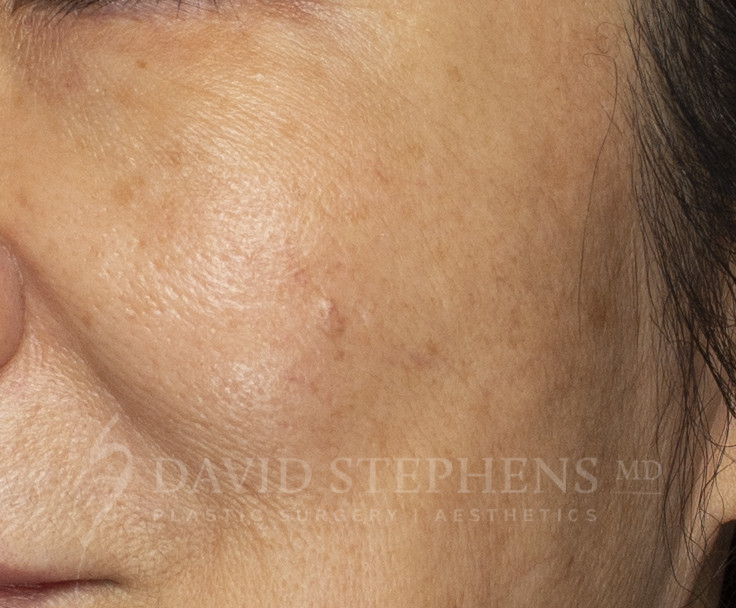 Halo-Patient-01 | After Halo