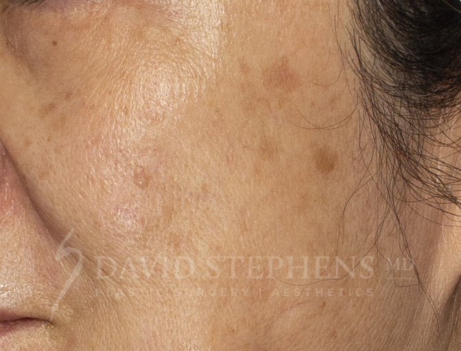 Halo-Patient-01 | Before Halo