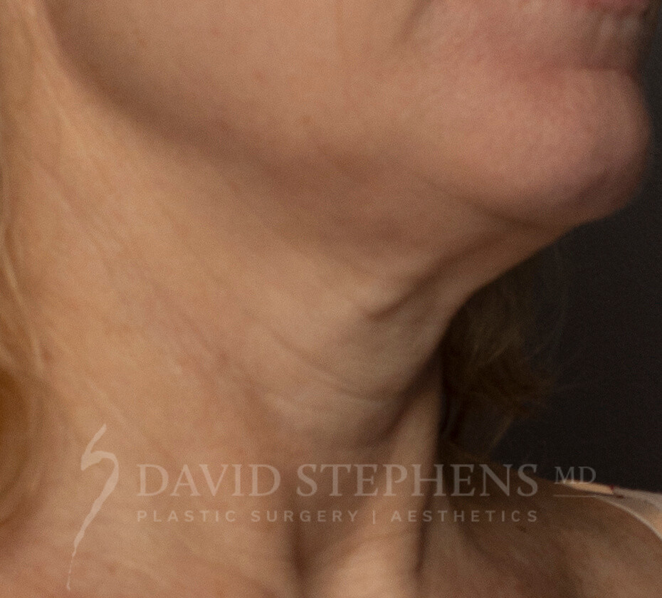 Halo-Patient-02 | Before Halo