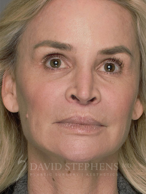 Halo-Patient-03 | After Halo