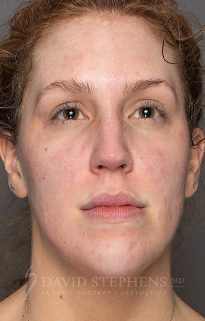 Halo-Patient-04 | Before Halo