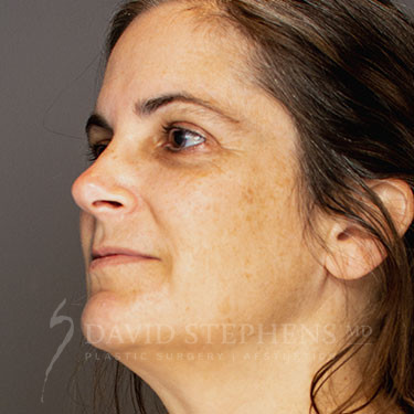 Halo-Patient-06 | Before Halo