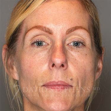 Halo-Patient-07 | After Halo