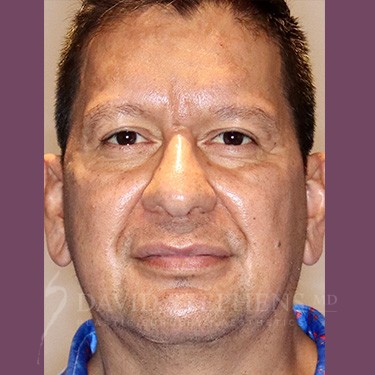 Halo-Patient-08 | After Halo