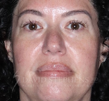 Halo-Patient-09 | After Halo