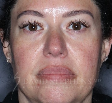 Halo-Patient-09 | Before Halo