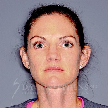 Halo-Patient-10 | After Halo