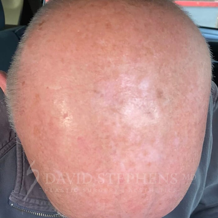overhead view of a male patient's bare head after BBL treatment with clear results
