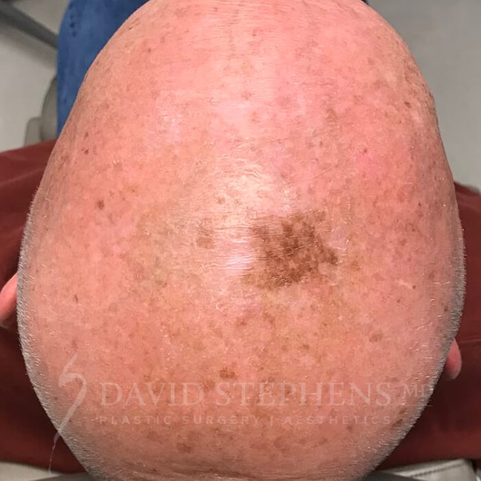 overhead view of a male patient's bare head before BBL treatment