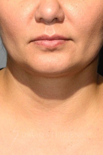 Kybella-Patient-01 | After Kybella