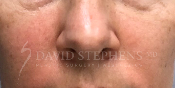 Lesion-Removal-Patient-01 | After Lesion Removal