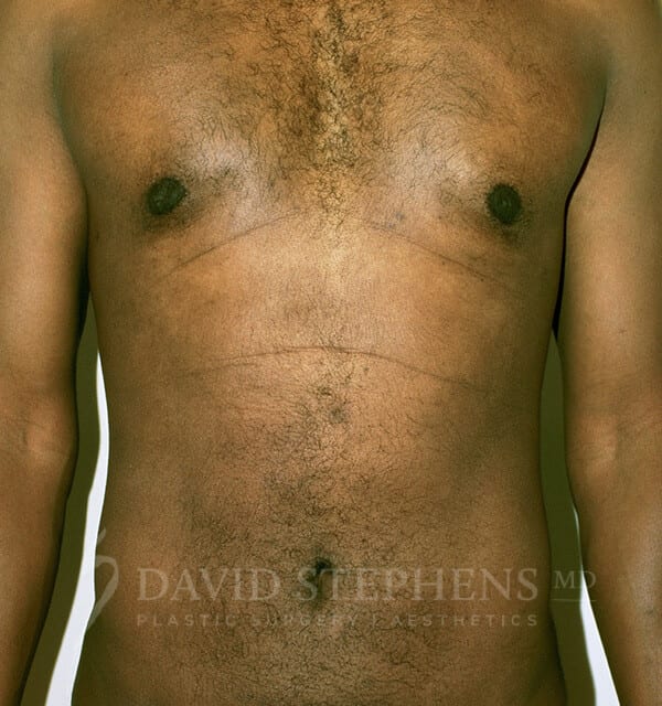 Liposuction-Patient-02 | After Body