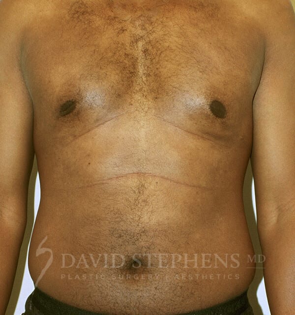 Liposuction-Patient-02 | Before Body