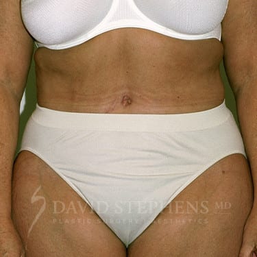 Body-Lift-Patient-04 | After Body