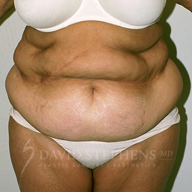 Body-Lift-Patient-04 | Before Body