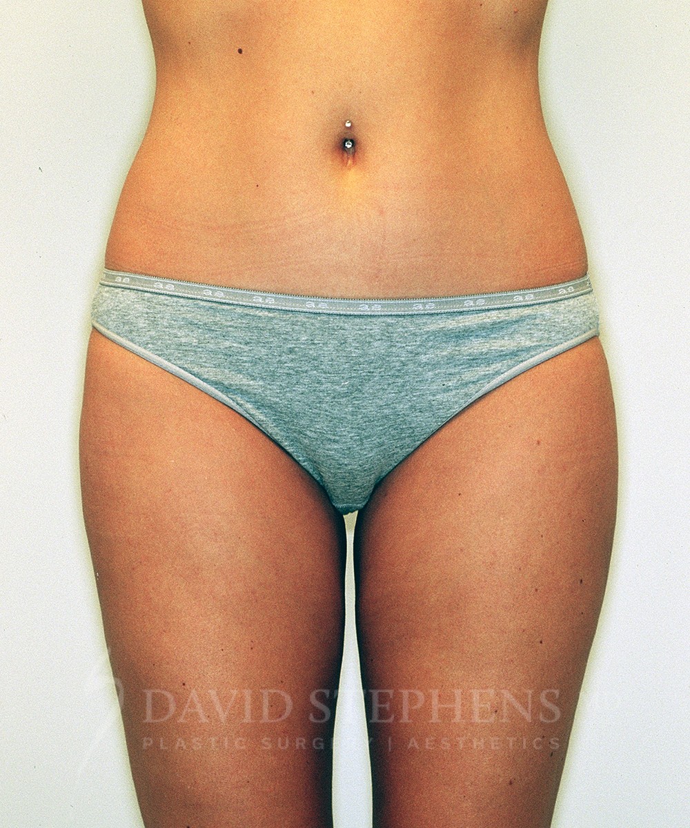 Liposuction-Patient-04 | After Body