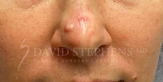 Lesion-Removal-Patient-01 | Before Lesion Removal