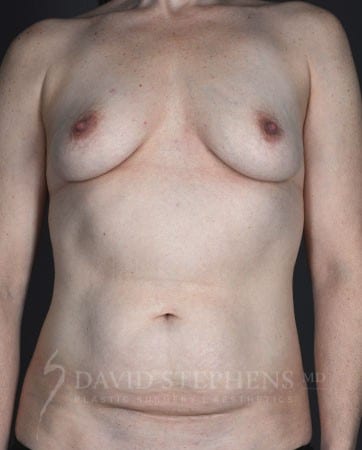 Mommy-Makeover-Patient-01 | Before Body