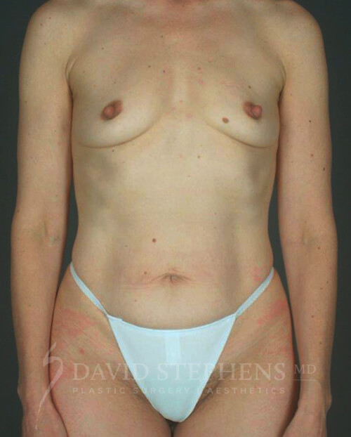 Mommy-Makeover-Patient-05 | Before Body