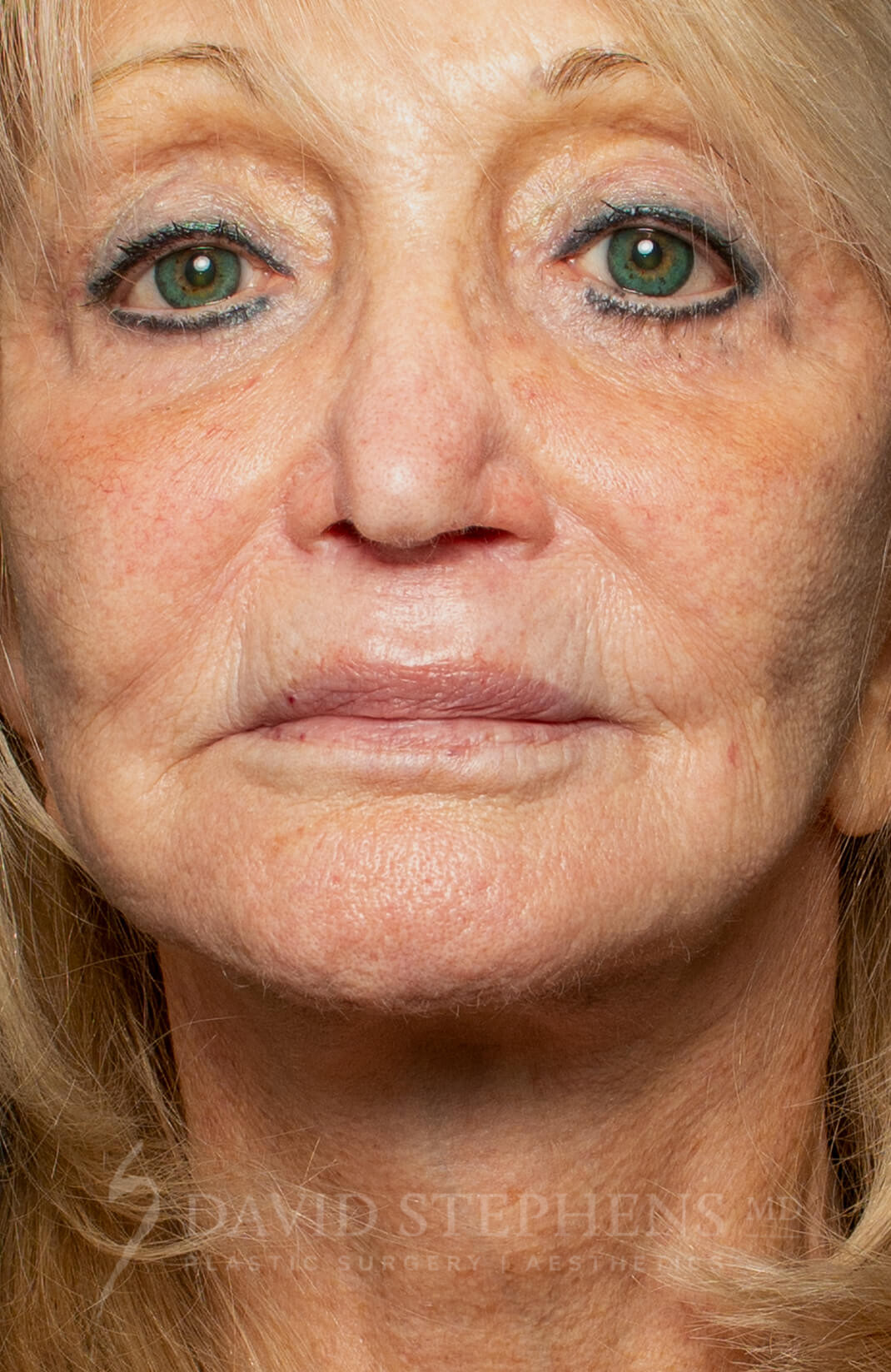 Morpeus8-Patient-01 | After Morpheus8