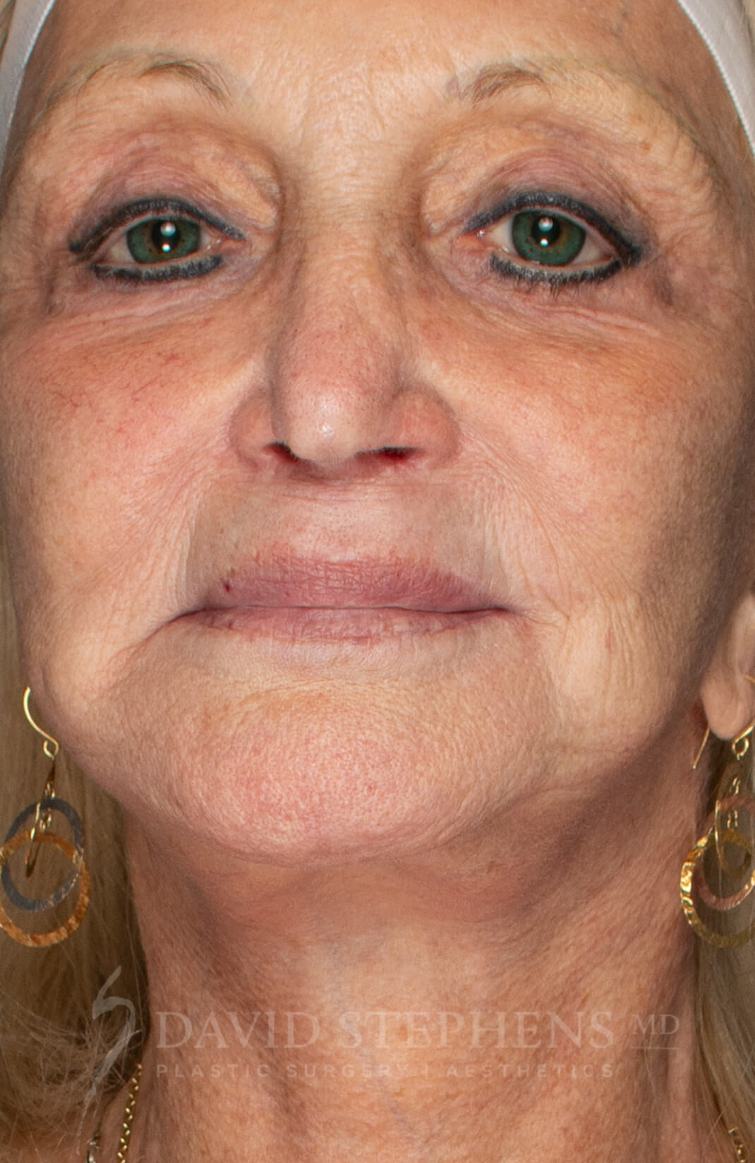 Morpeus8-Patient-01 | Before Morpeus8