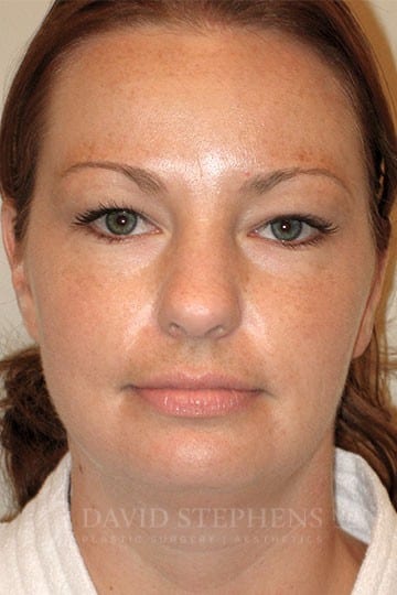 Neck-Liposuction-Patient-01 | Before Neck/Chin Liposuction