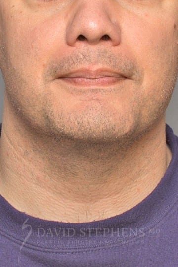 Cosmetic Surgery for Men - Actual Patient Results - After - 2