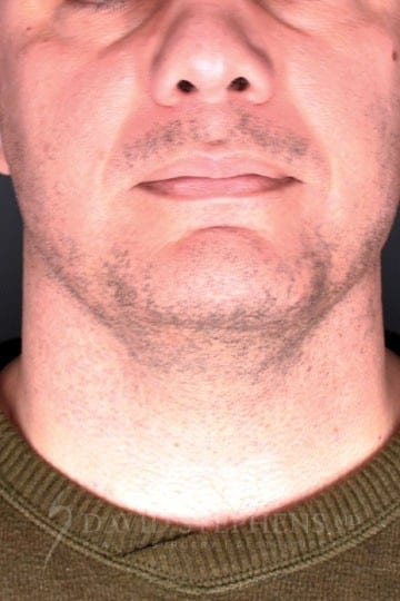 Cosmetic Surgery for Men - Actual Patient Results - Before - 2