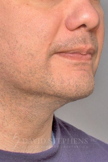 Male Facelift and Neck Lift - Actual Patient Results - After - 2
