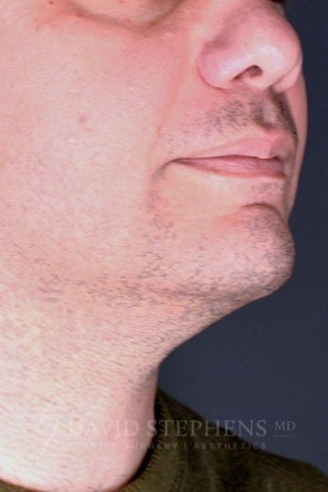 Male Facelift and Neck Lift - Actual Patient Results - Before - 2