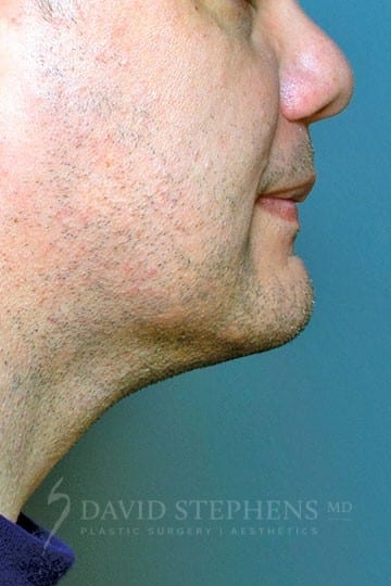 Male Facelift and Neck Lift - Actual Patient Results - After - 3