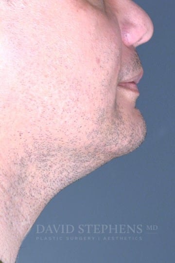 Male Facelift and Neck Lift - Actual Patient Results - Before - 3