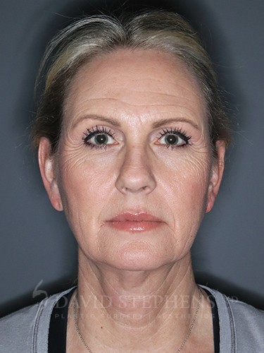 Facelift-Patient-15 | Before Surgical